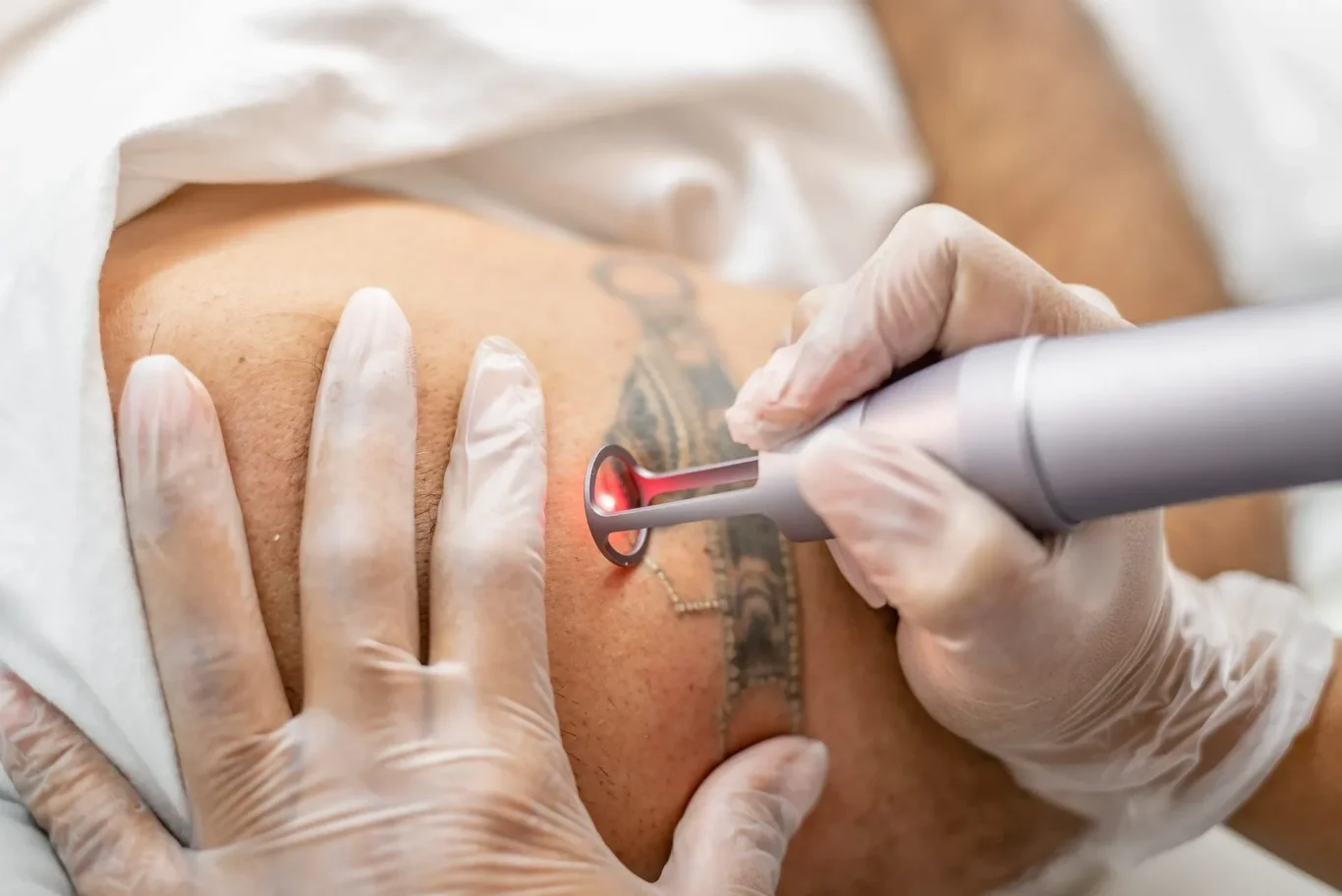 Eliminación de Tatuajes con Picolaser, sistema SPT